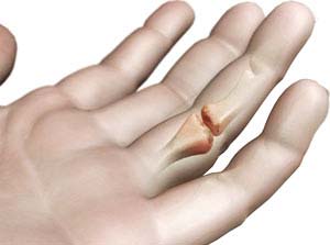 Arthritis of the Hand and Wrist