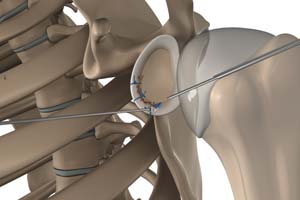  Arthroscopic Bankart Repair