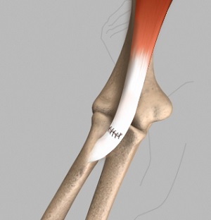 Distal Biceps Repair