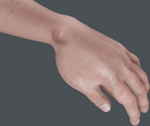  Ganglion Cysts