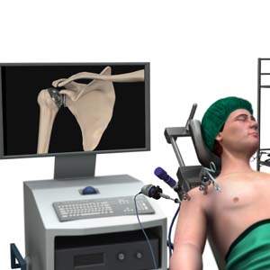  Minimally Invasive Shoulder Joint Replacement