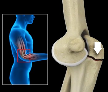 ORIF of the Olecranon Fractures