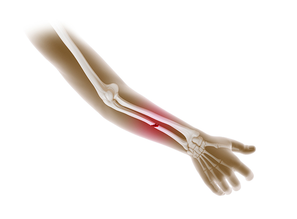 Proximal Forearm Fracture