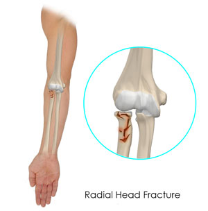 Radial Head Fractures