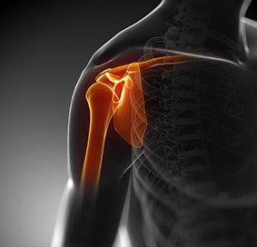 Am I a Candidate for Shoulder Replacement?