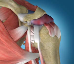  Shoulder Impingement