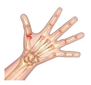 Arthritis of the Thumb